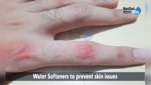 Water Softener Skin Problems