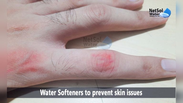 Water Softener Skin Problems
